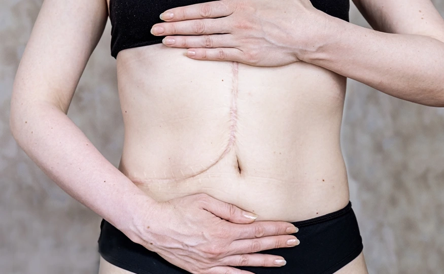 InformaçõesCicatriz Alargada