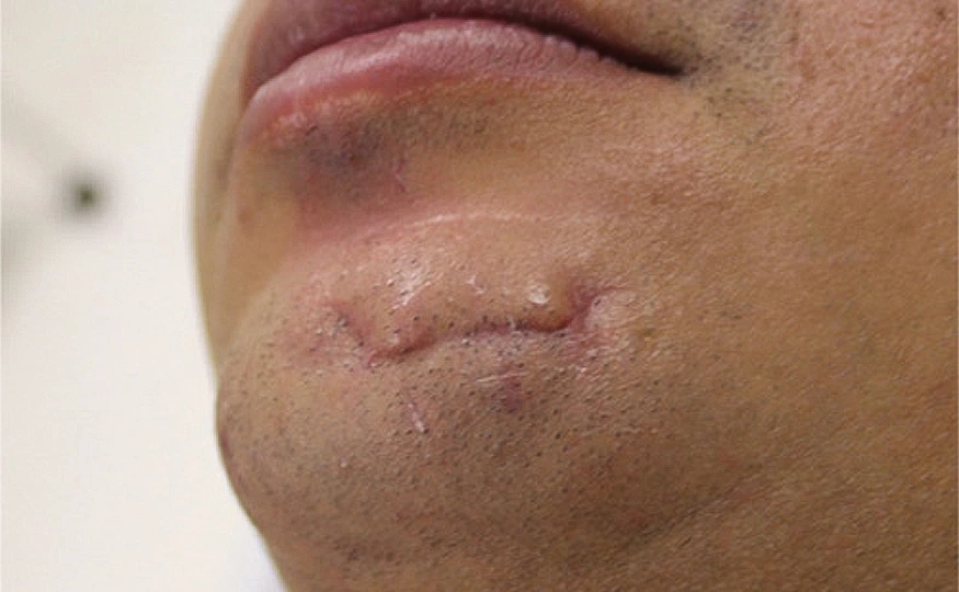 InformaçõesCicatriz 