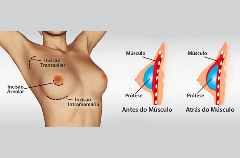 Informações Técnica cirurgica