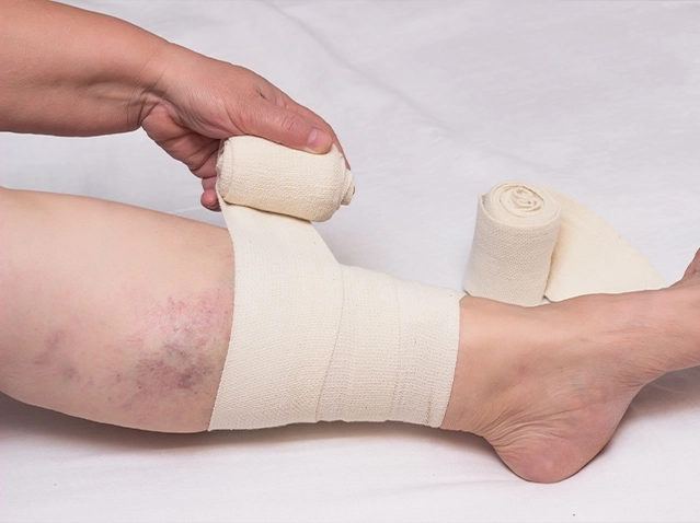 PrevençãoTrombose e tromboembolismo