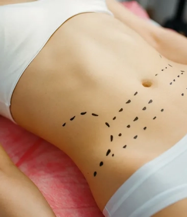 Abdominoplastia: o que você precisa saber sobre esse procedimento?