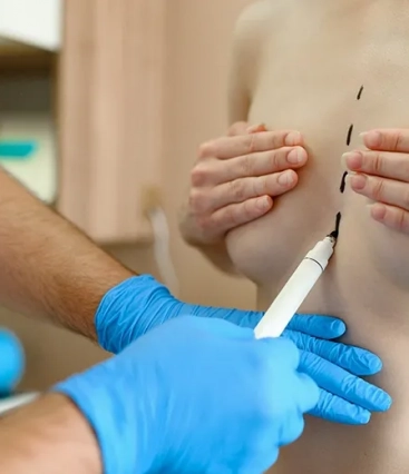 Aprovado direito a troca do implante mamário para pacientes de câncer