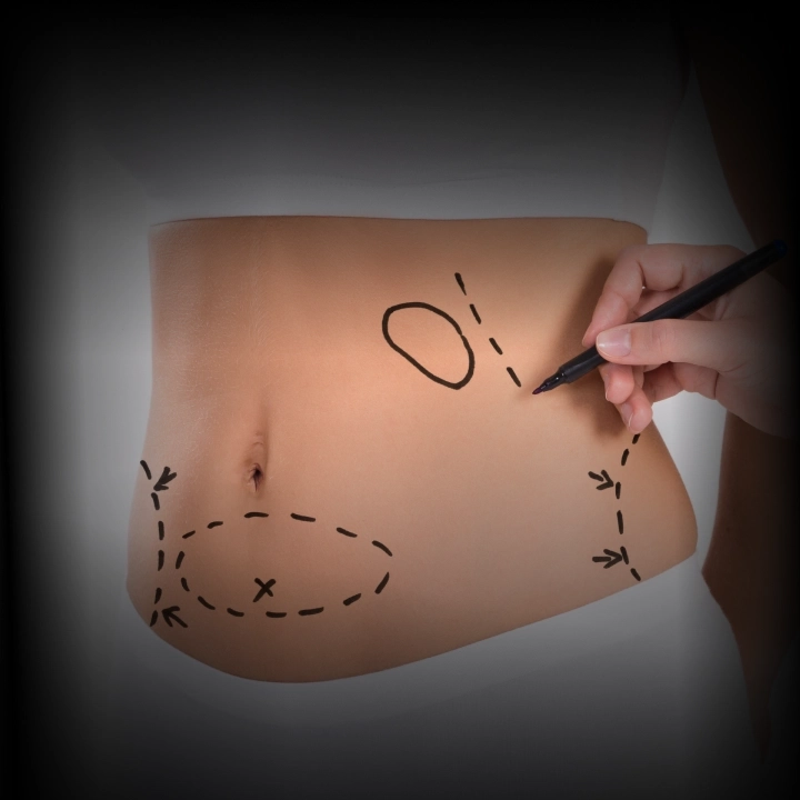 Procedimento Lipoescultura