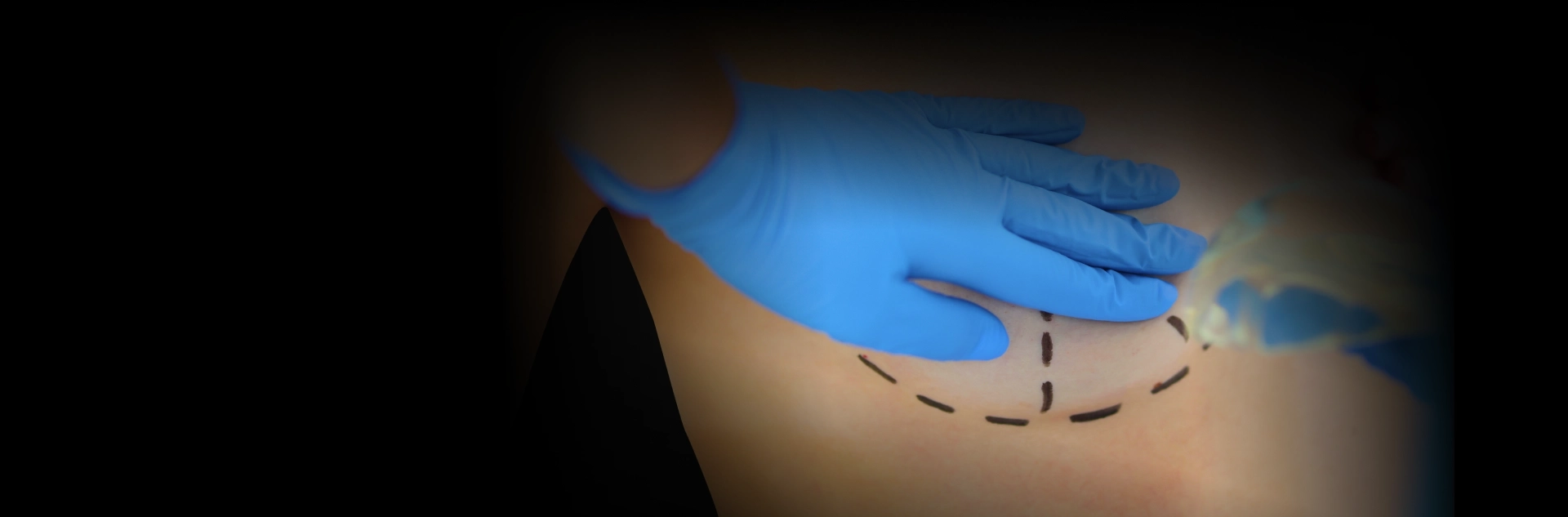 Procedimentos Redução de Mama ou Suspensão dos Seios (Mamoplastia)