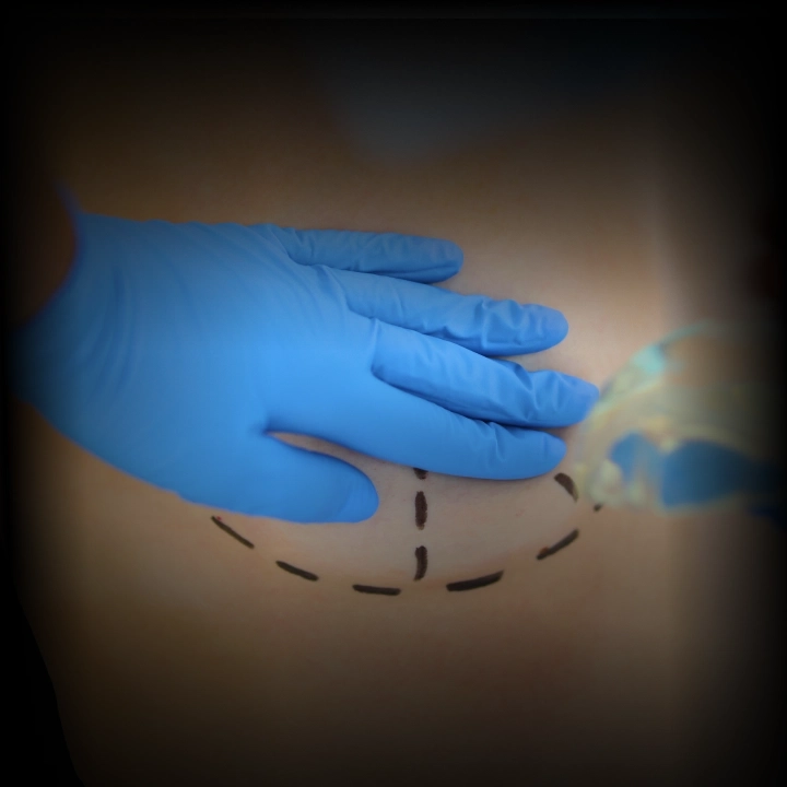 Procedimentos Redução de Mama ou Suspensão dos Seios (Mamoplastia)