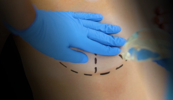 Mamoplastia Estruturada