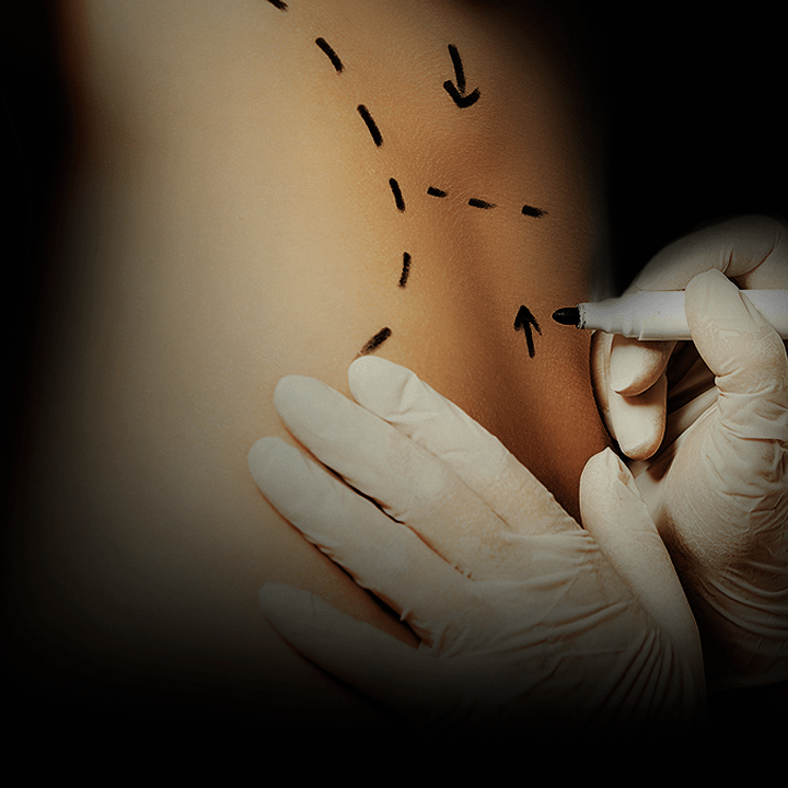 Procedimentos Mommy Makeover(Cirurgia Pós Gravidez) 