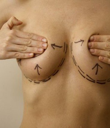 Cirurgia de mama com Funil de Keller