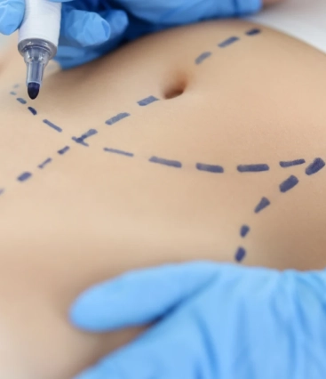 Mommy Makeover para mulheres que não desejam mais ter filhos: é uma boa opção?