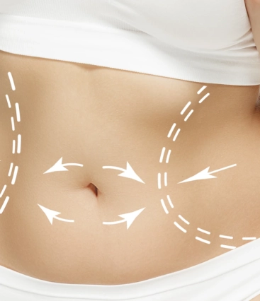 Cirurgias pós-parto para perda de peso são uma boa opção?