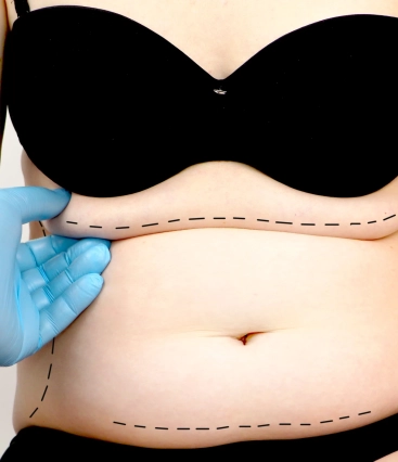 Quais são os riscos e possíveis complicações da lipoaspiração: como preveni-los e tratá-los?