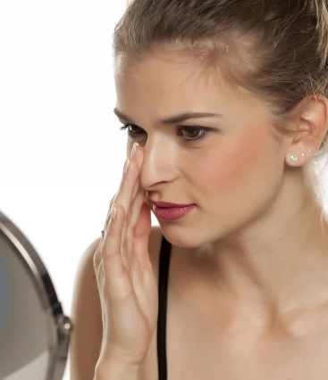 Quanto tempo depois da rinoplastia posso assoar o nariz