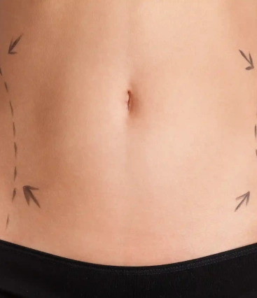 Quanto tempo depois da abdominoplastia posso agachar