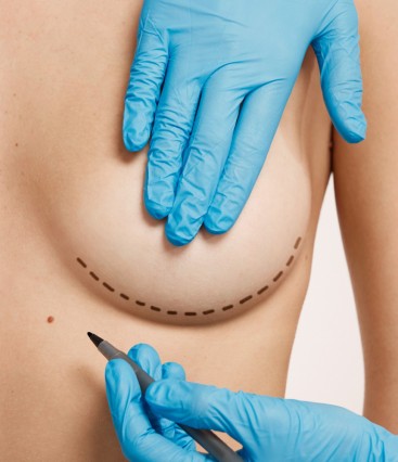 Cicatrizes na cirurgia de mama: tudo o que você precisa saber