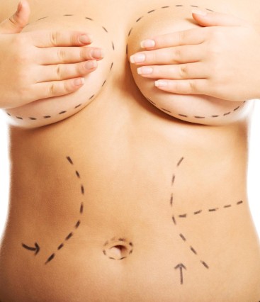 Mommy Makeover: tudo o que você precisa saber