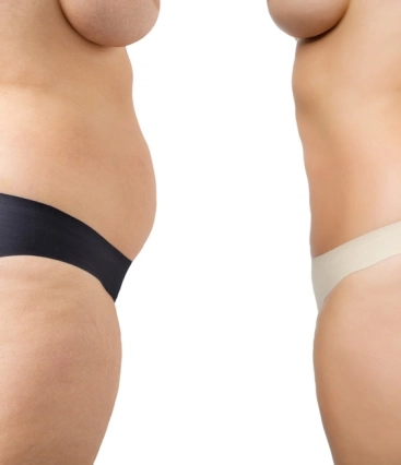 Qual a diferença entre a lipoaspiração tradicional e a lipo com argoplasma?