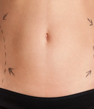 Para que serve o argoplasma na cirurgia plástica? Entenda quando essa tecnologia é indicada